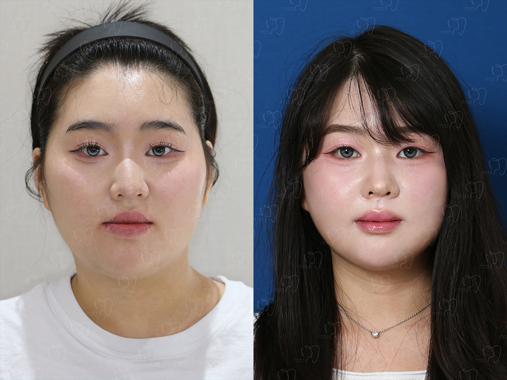 맥스구강악안면외과 수술 전후사진