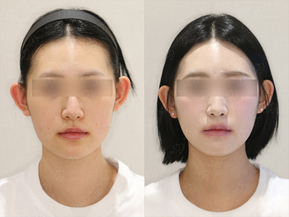 맥스구강악안면외과 수술 전후사진