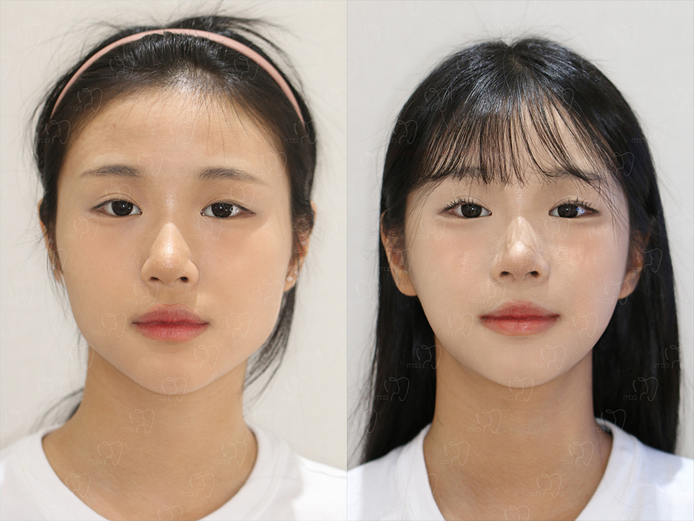 맥스구강악안면외과 수술 전후사진
