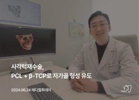 사각턱 재수술, PCL+ß-TCP로 자가골 형성 유도