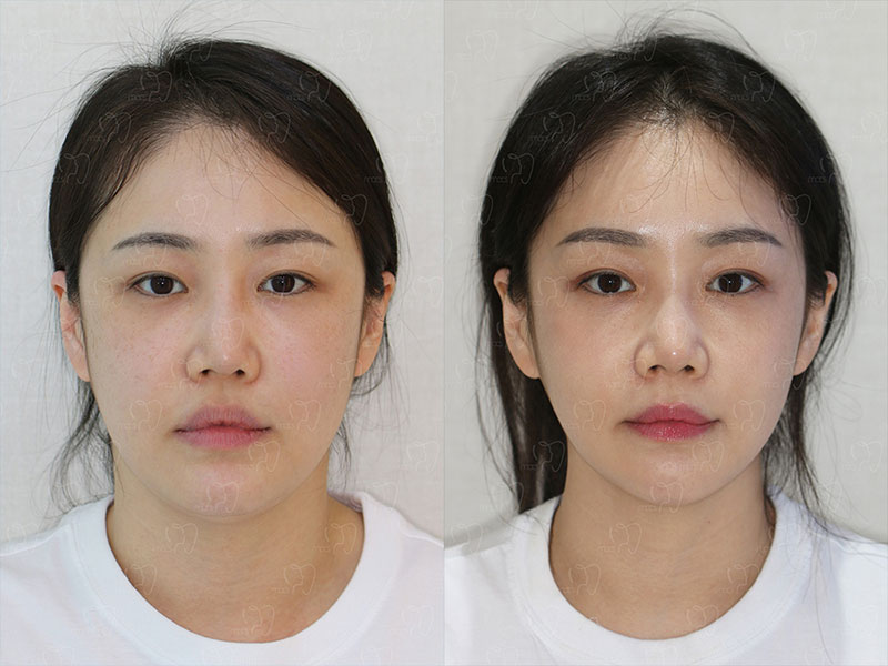 맥스구강악안면외과 수술 전후사진