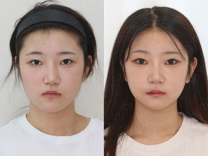 맥스구강악안면외과 수술 전후사진