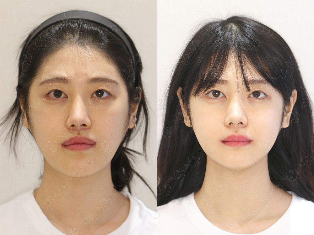 맥스구강악안면외과 수술 전후사진