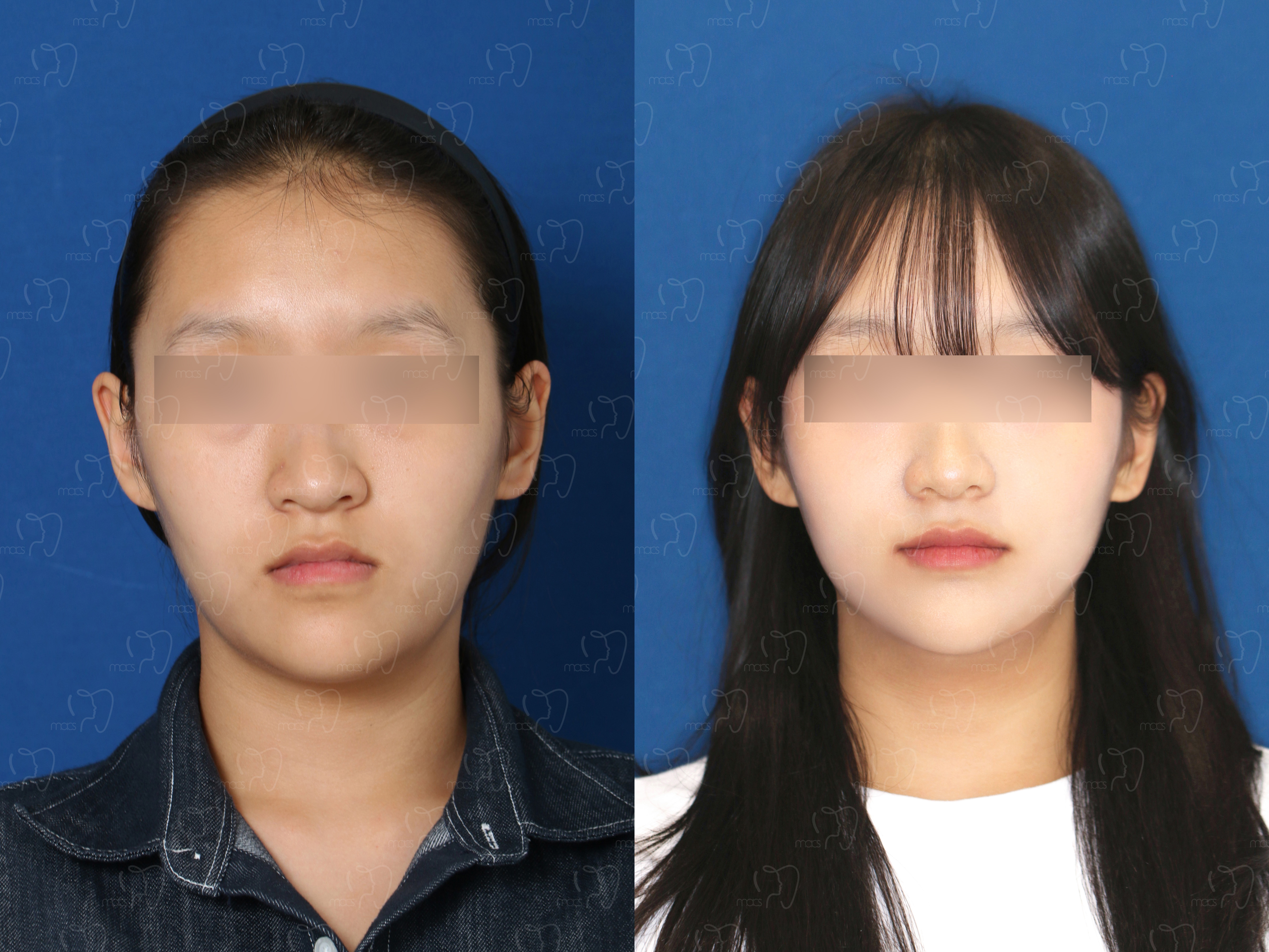 맥스구강악안면외과 수술 전후사진