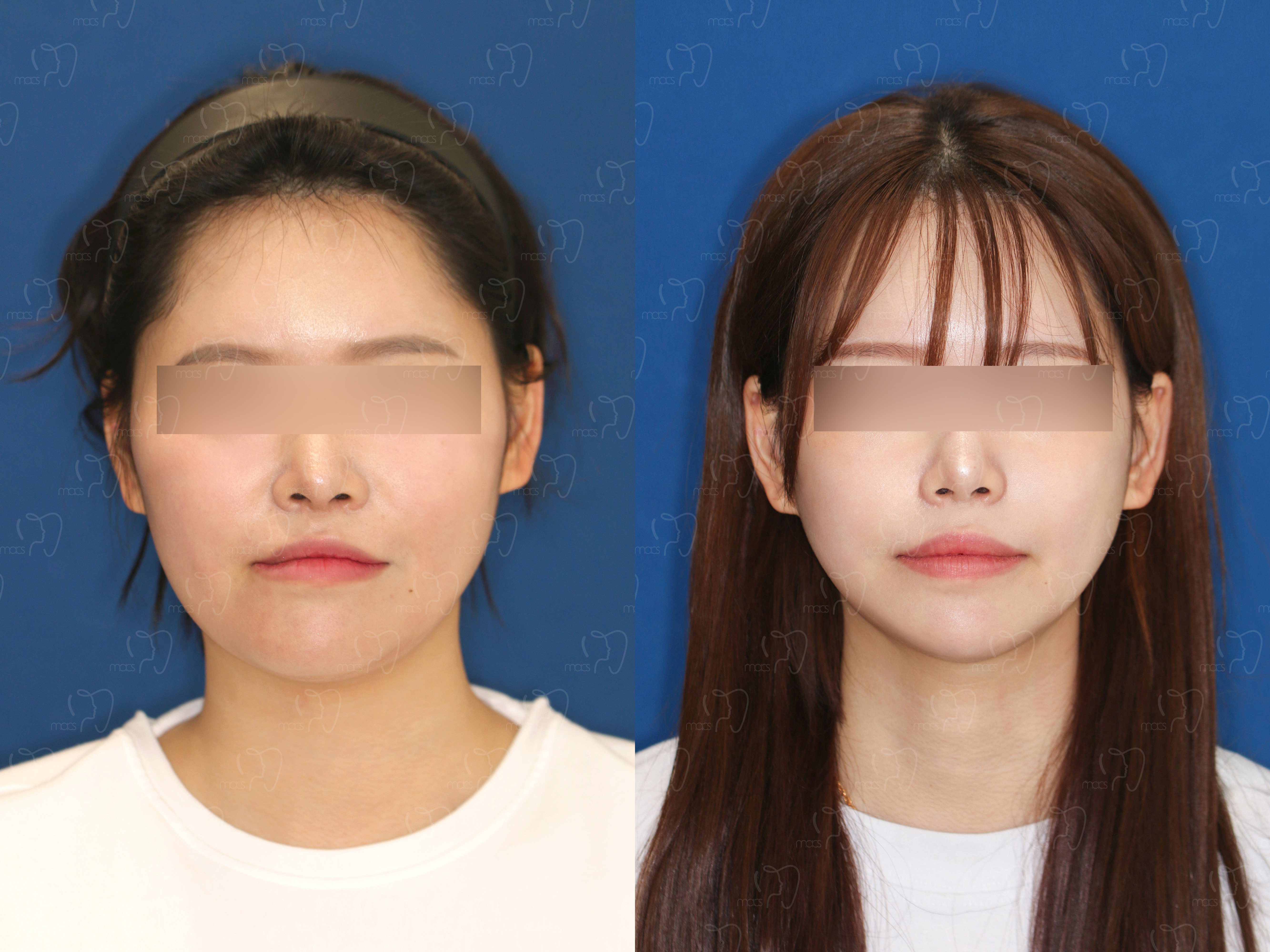 맥스구강악안면외과 수술 전후사진