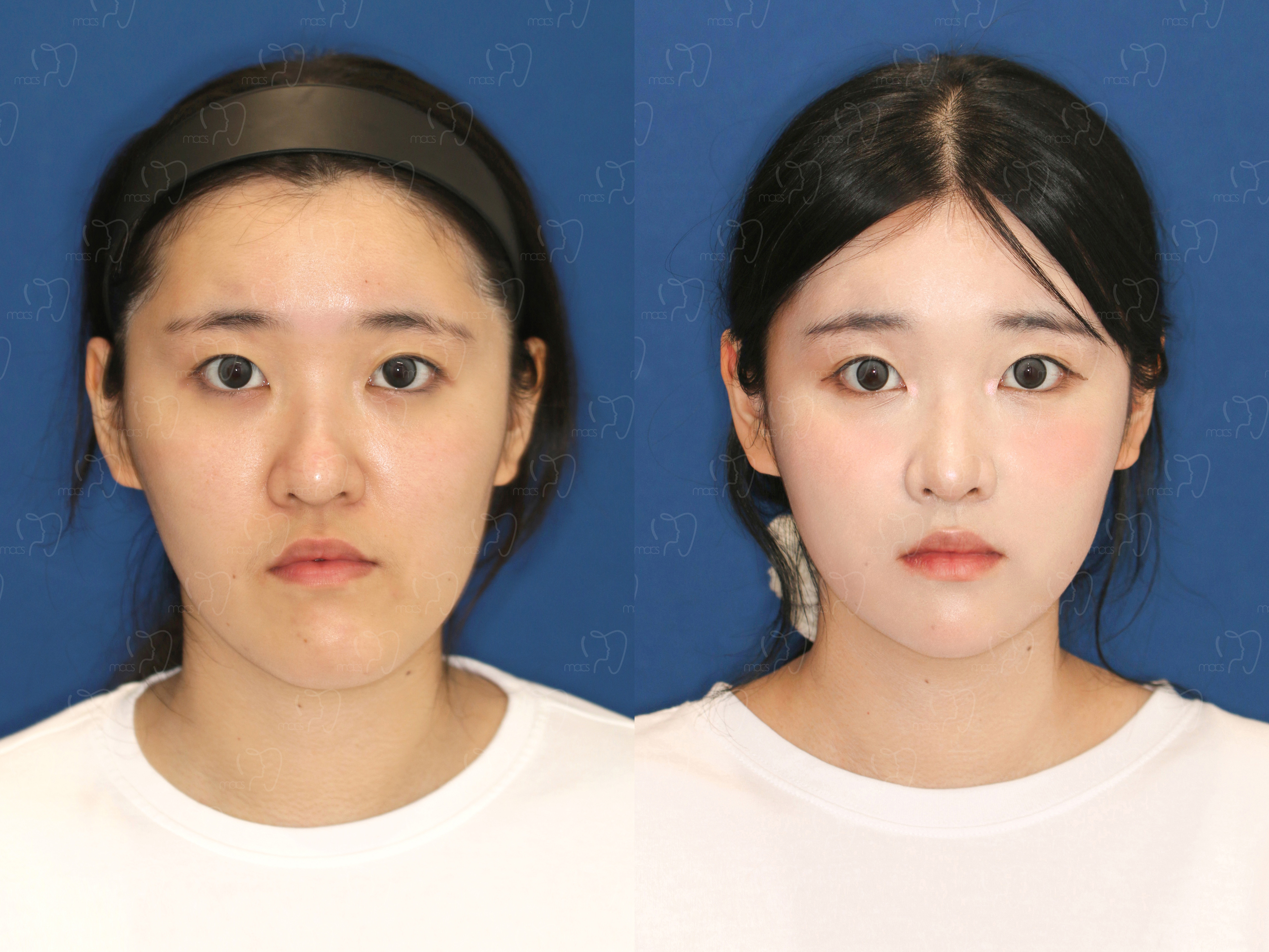 맥스구강악안면외과 수술 전후사진