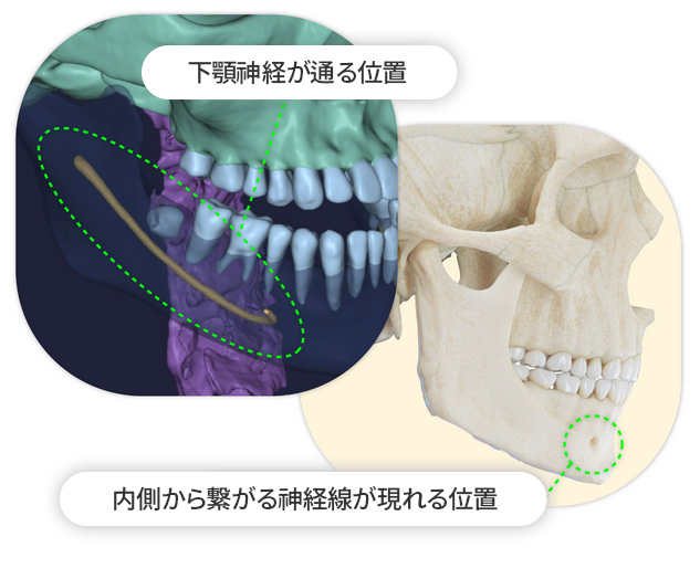 Vライン手術!