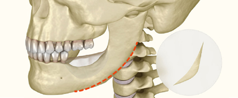 Surgical Methods for Each Case of 3-Type Contouring