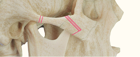 Surgical Methods for Each Case of 3-Type Contouring