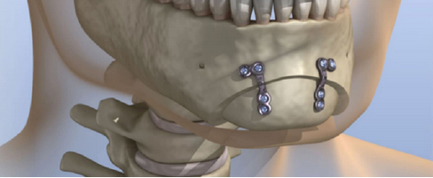 Surgical Methods for Each Case of 3-Type Contouring