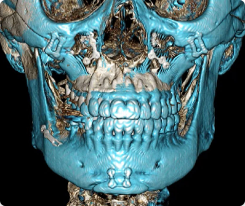 Zygoma + Square Jaw + Chin Tip Before & After