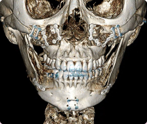 Zygoma + Square Jaw + Chin Tip Before & After