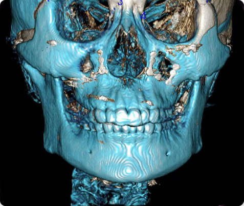 Zygoma + Square Jaw + Chin Tip Before & After