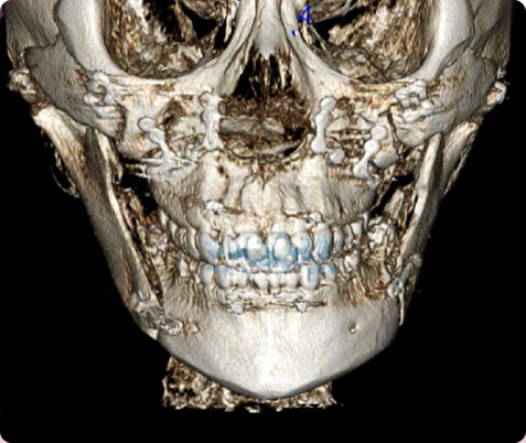 Zygoma + Square Jaw + Chin Tip Before & After