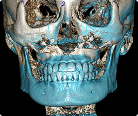 Zygoma + Square Jaw + Chin Tip Before & After
