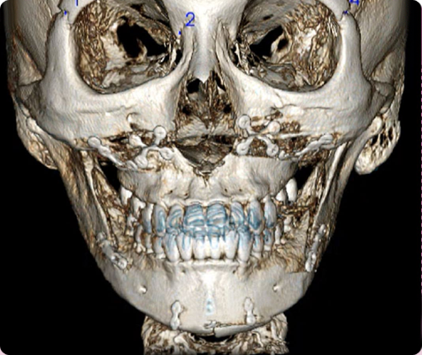 Zygoma + Square Jaw + Chin Tip Before & After
