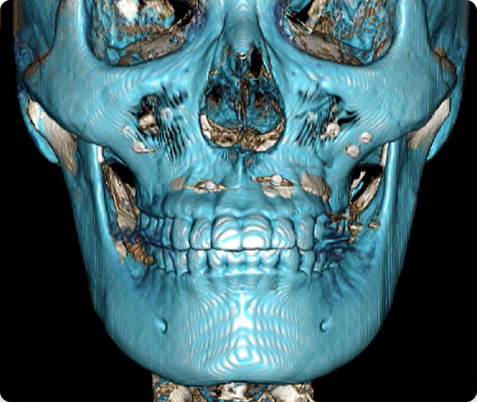 Zygoma + Square Jaw + Chin Tip Before & After