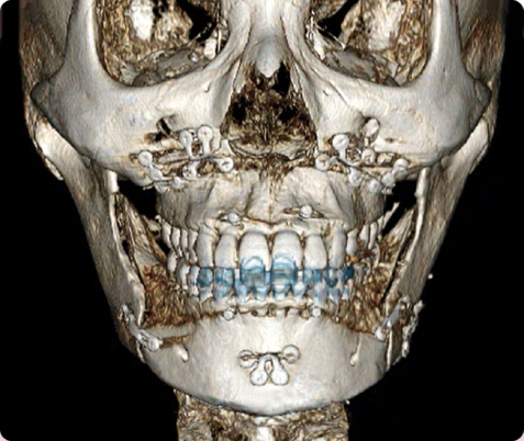 Zygoma + Square Jaw + Chin Tip Before & After