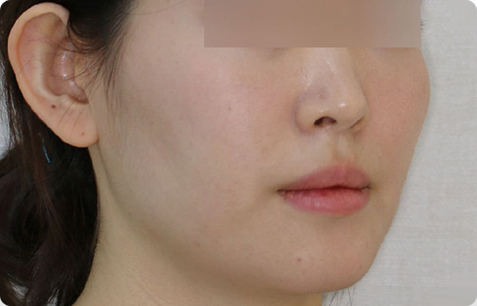 Zygoma + Square Jaw + Chin Tip Before & After