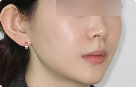 Zygoma + Square Jaw + Chin Tip Before & After