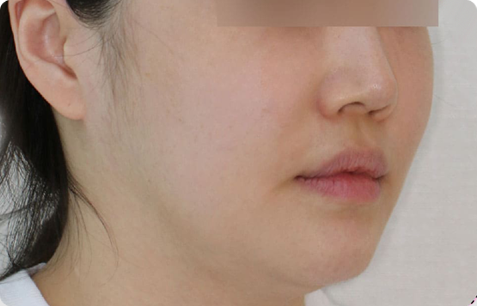 Zygoma + Square Jaw + Chin Tip Before & After
