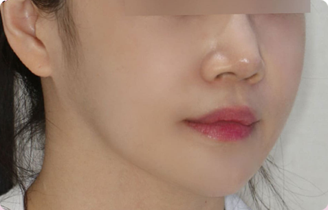 Zygoma + Square Jaw + Chin Tip Before & After