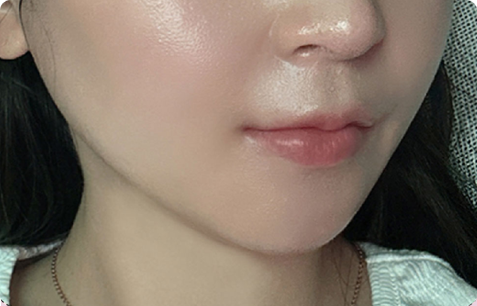 MACS 수술 전후사진