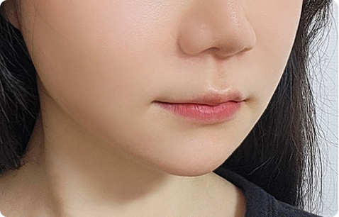 MACS 수술 전후사진